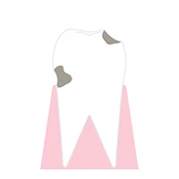 C2：象牙質虫歯